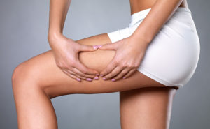 Cellulite adiposita corpo - Dott. Massimo Luni - Medicina estetica Torino