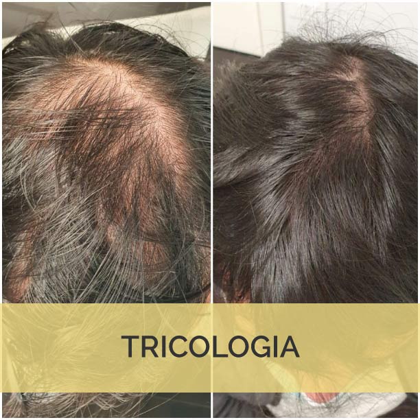 Oltre il trapianto, i trattamenti per la perdita dei