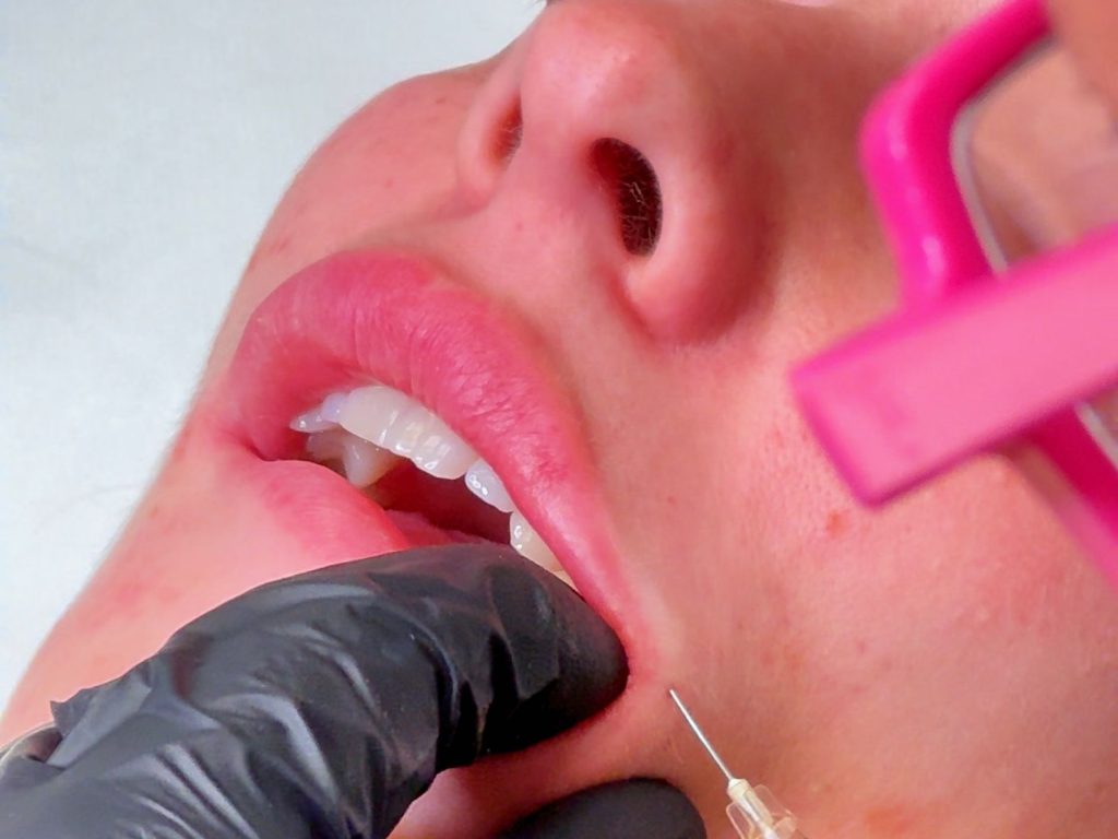 tipologie filler labbra