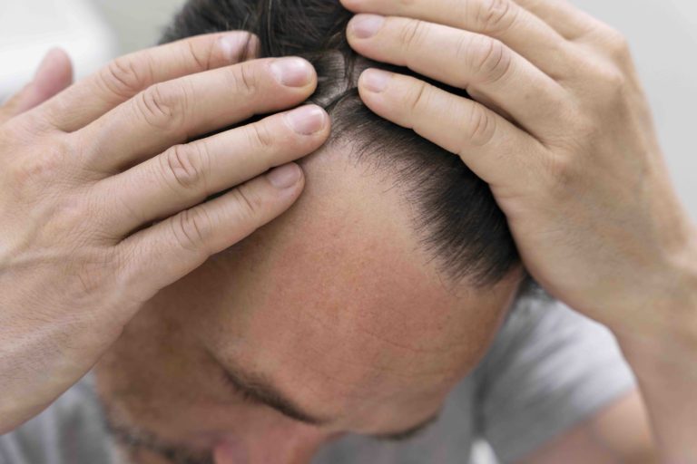 come fermare la caduta dei capelli