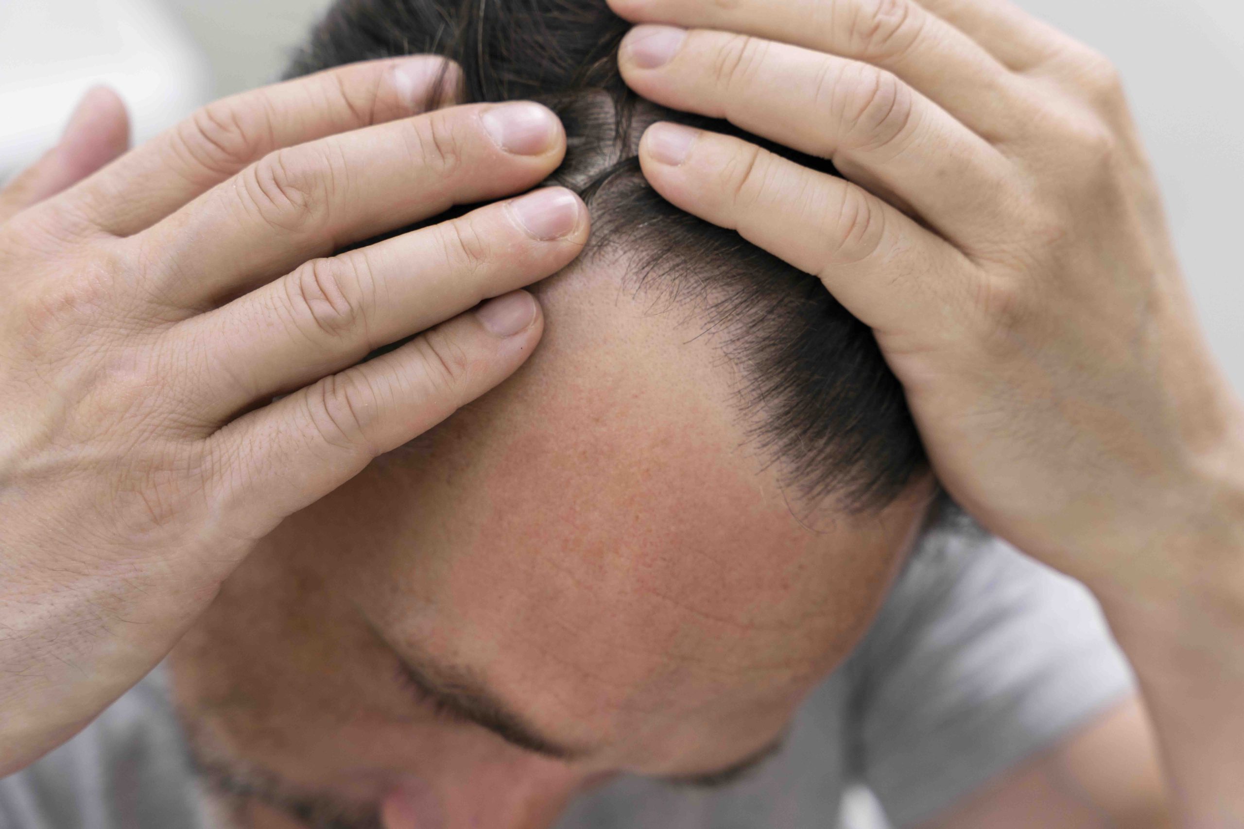 come fermare la caduta dei capelli
